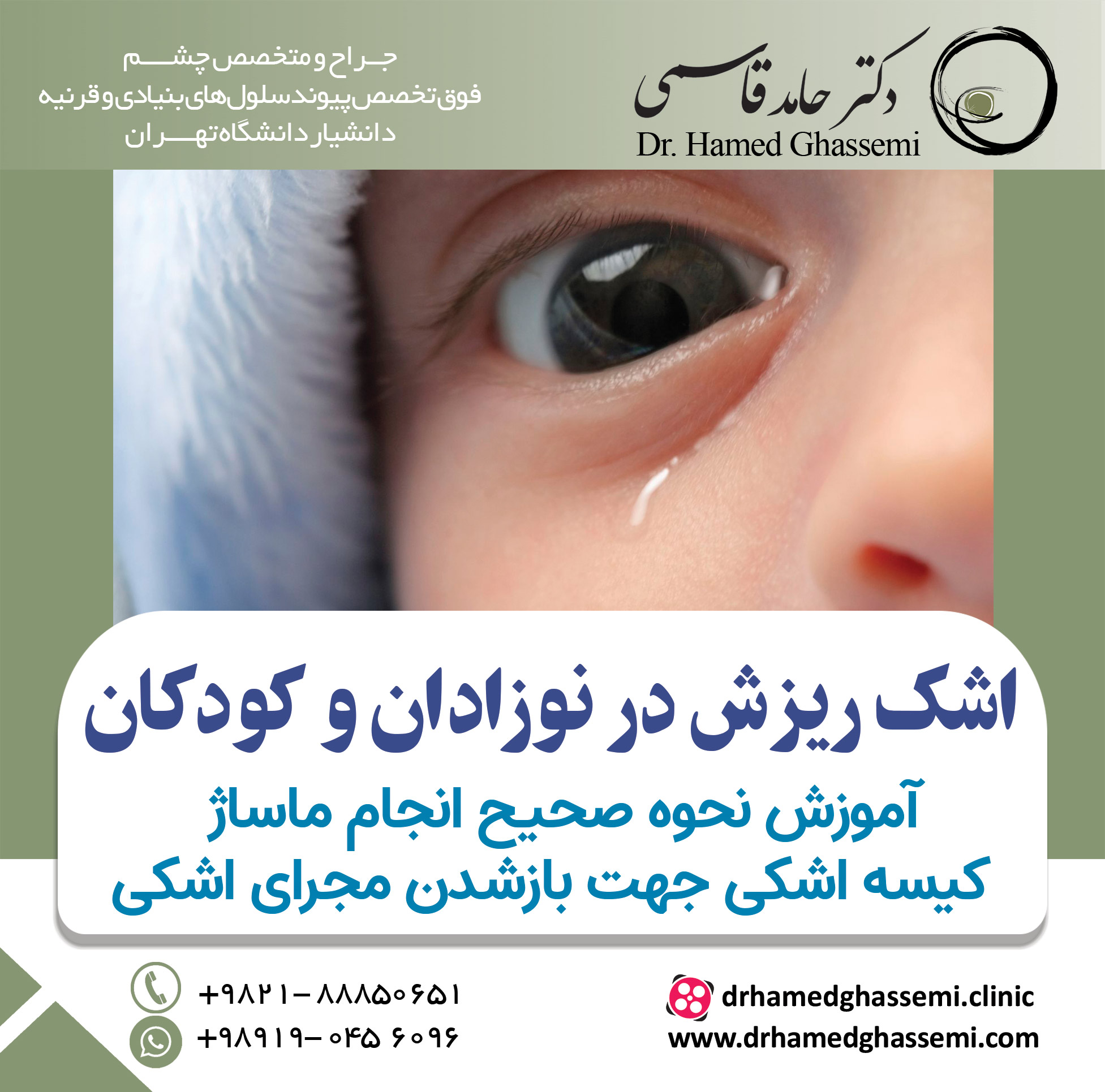 اشکریزش در نوزادان و کودکان، آموزش نحوه صحیح انجام ماساژ کیسه اشکی جهت بازشدن مجرای اشکی در شیرخواران زیر۱۲ماه