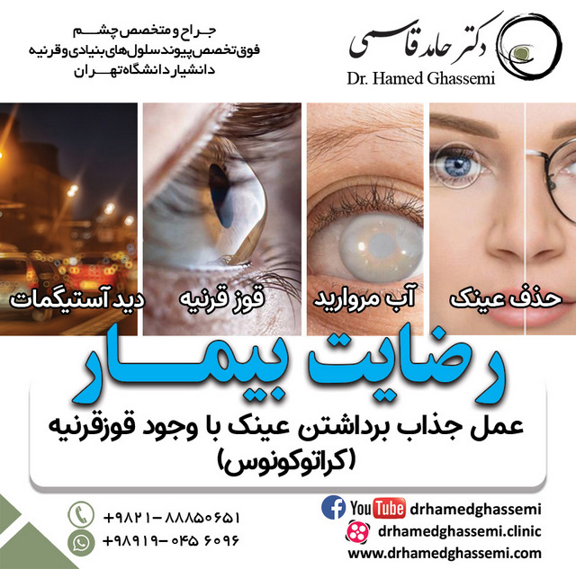 عمل جذاب برداشتن عینک با وجود قوزقرنیه (کراتوکونوس)