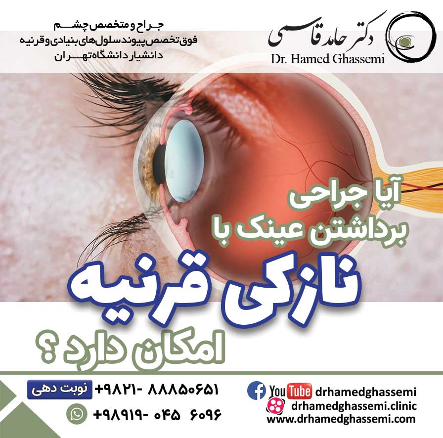 نازکی قرنیه 