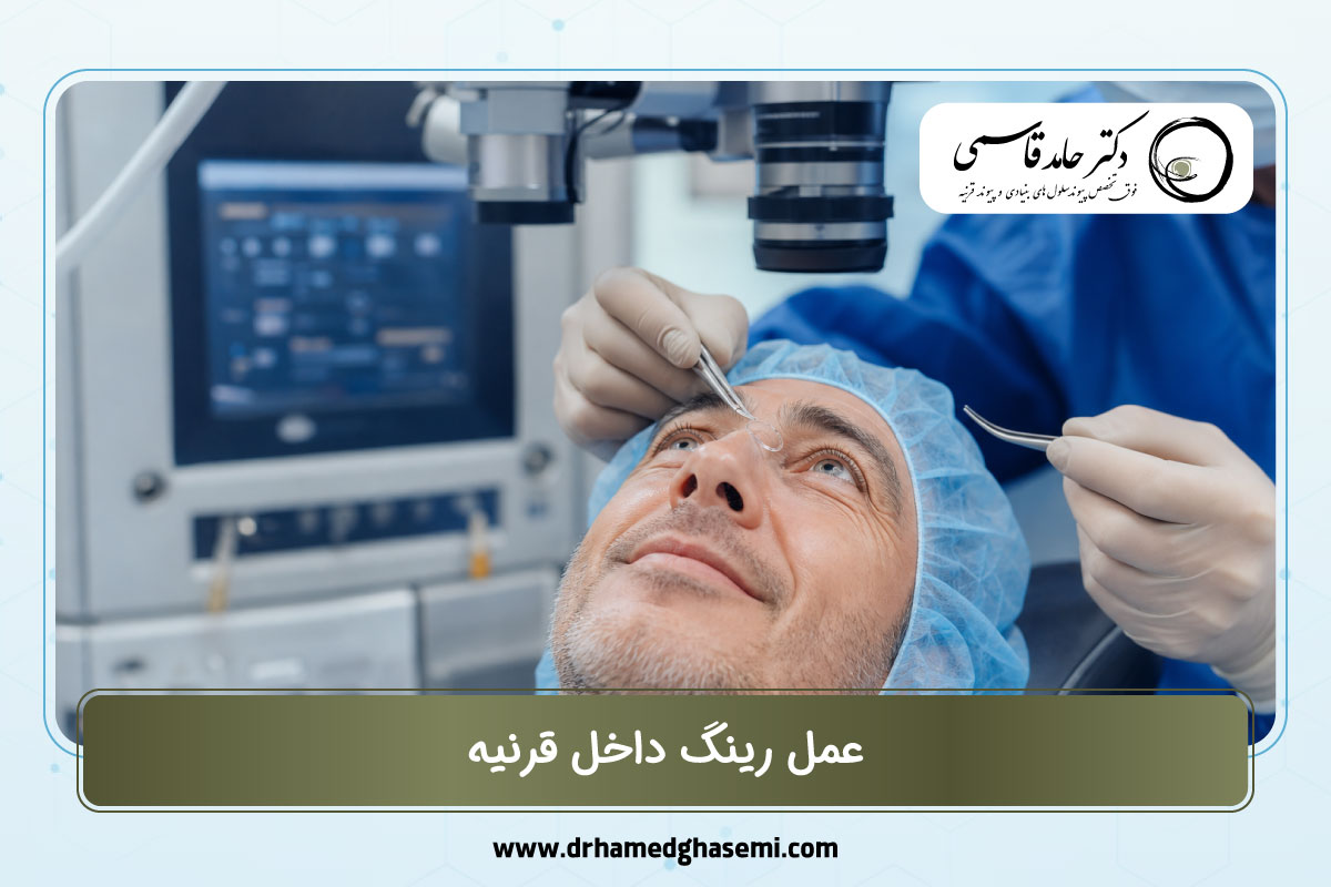 عمل رینگ داخل قرنیه