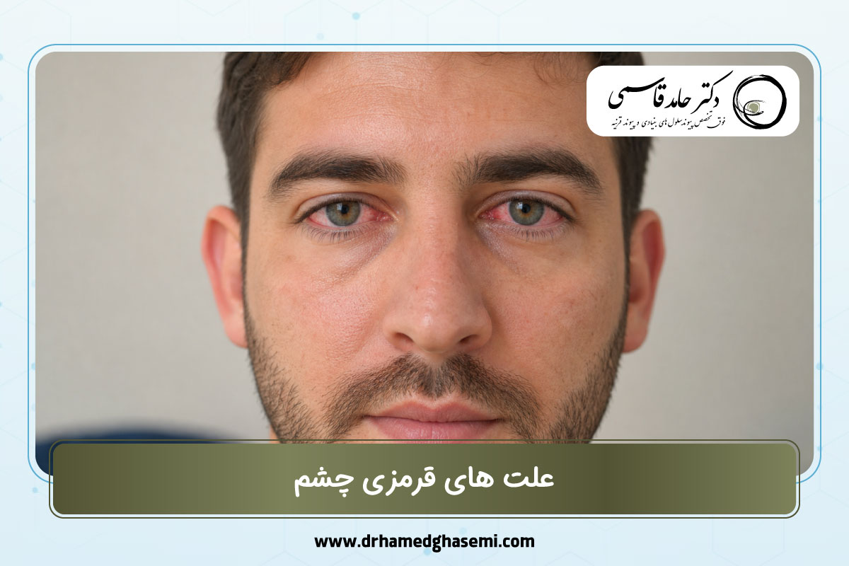 علت های قرمزی چشم
