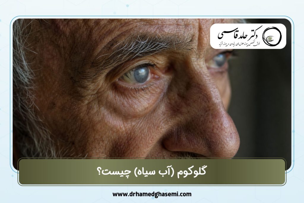 گلوکوم یا آب سیاه چیست؟