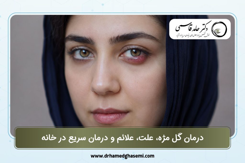 درمان گل مژه