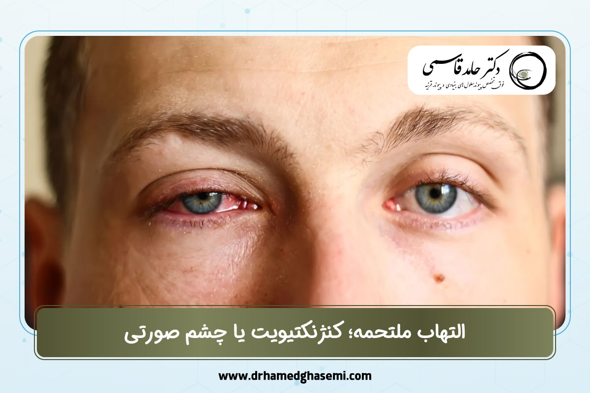 التهاب ملتحمه؛ کنژنکتیویت یا چشم صورتی