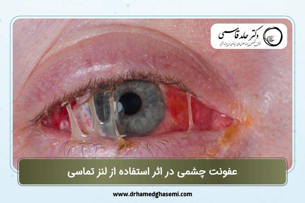 عفونت چشمی