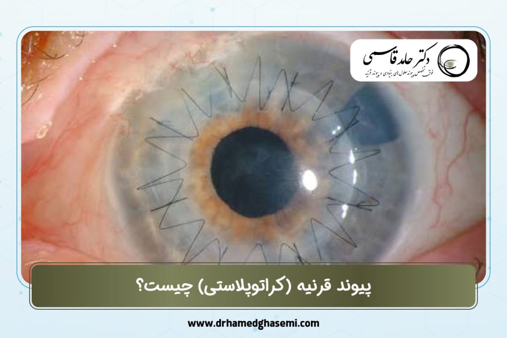 پیوند قرنیه (کراتوپلاستی)