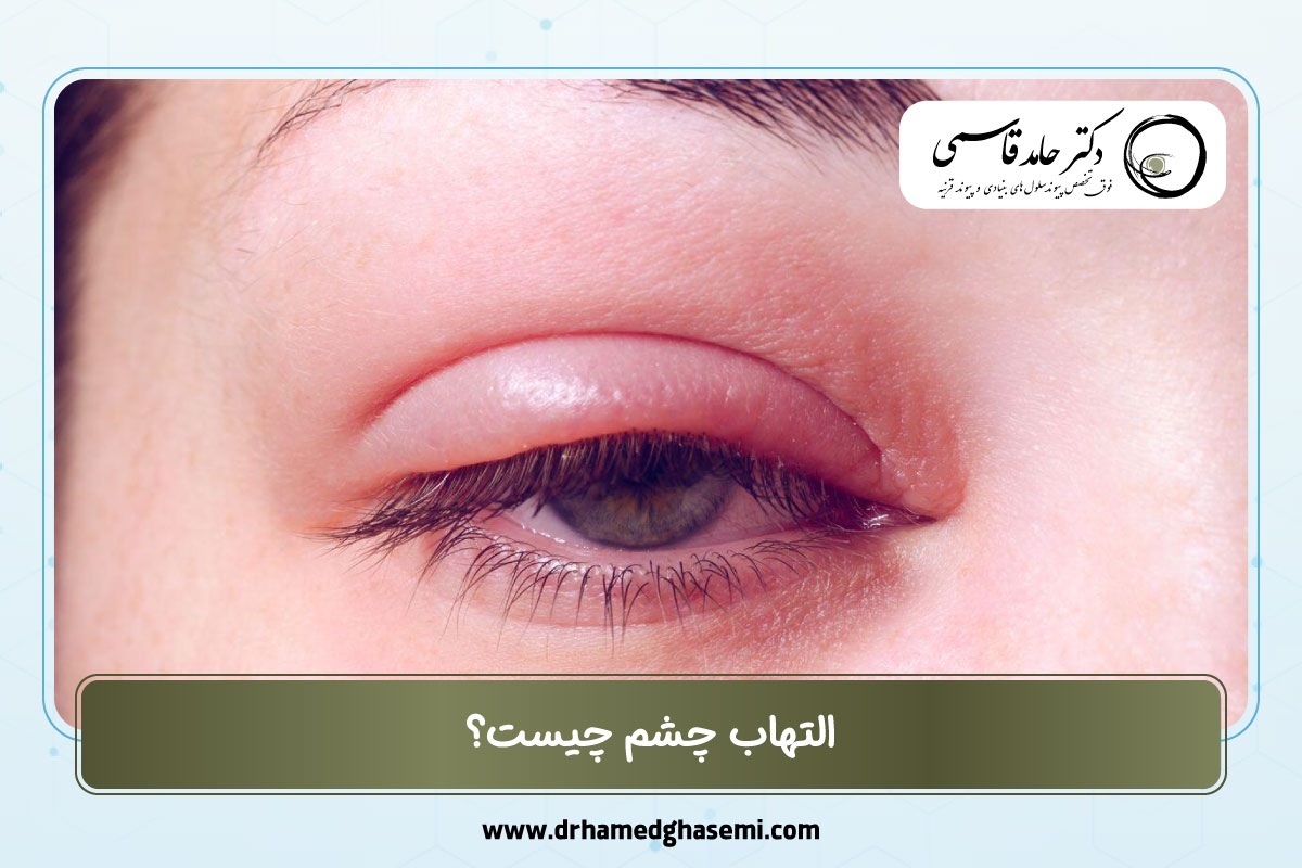 التهاب چشم چیست؟