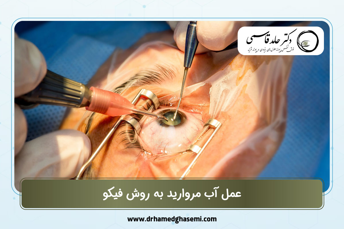 عمل آب مروارید به روش فیکو