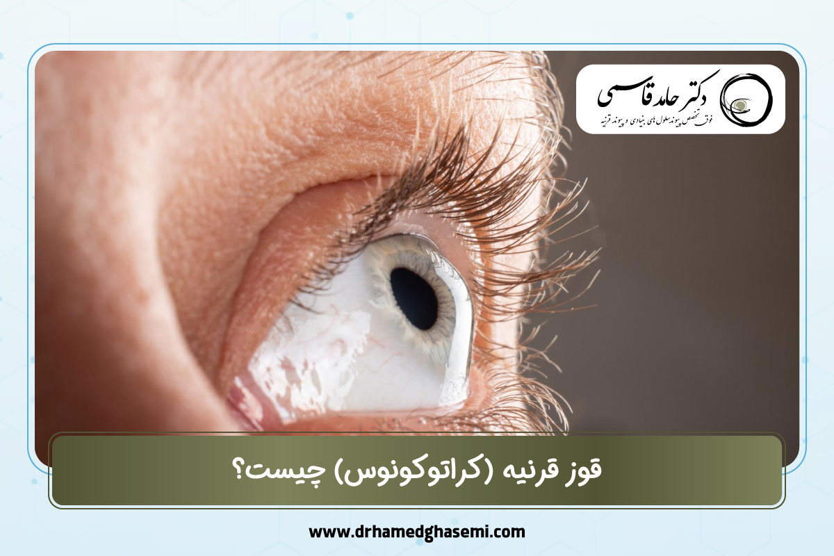 قوز قرنیه (کراتوکونوس) چیست؟